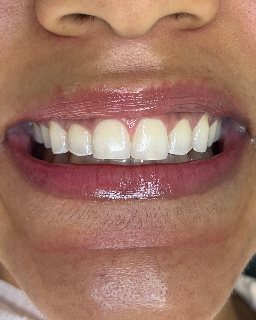 Depois do clareamento dental