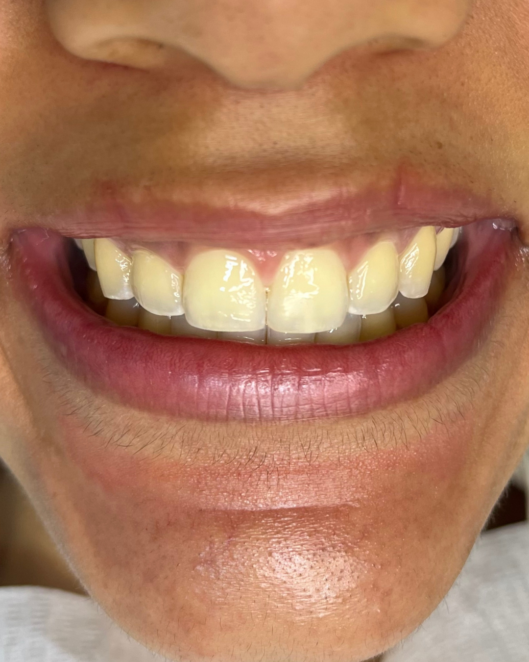 Antes do clareamento dental